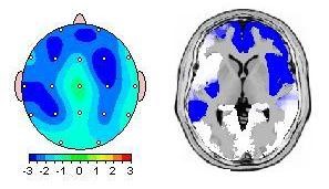 روش تفسیر QEEG(نقشه مغزی)