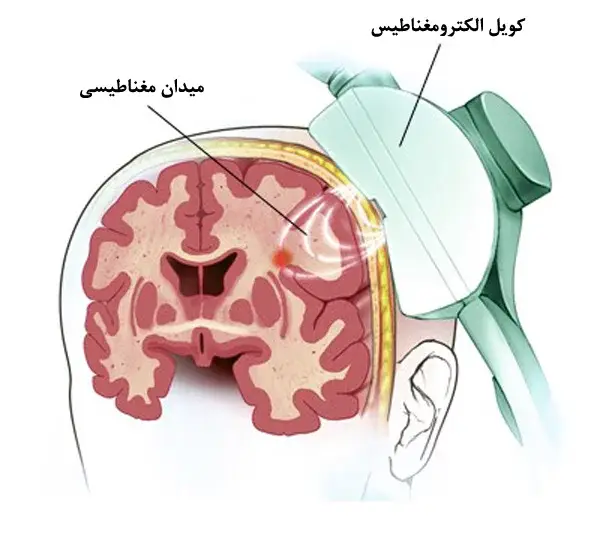 آرتی ام اس چه تاثیراتی دارد
