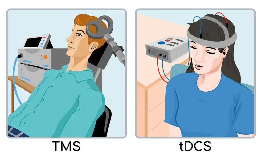 تفاوت RTMS و TDCS
