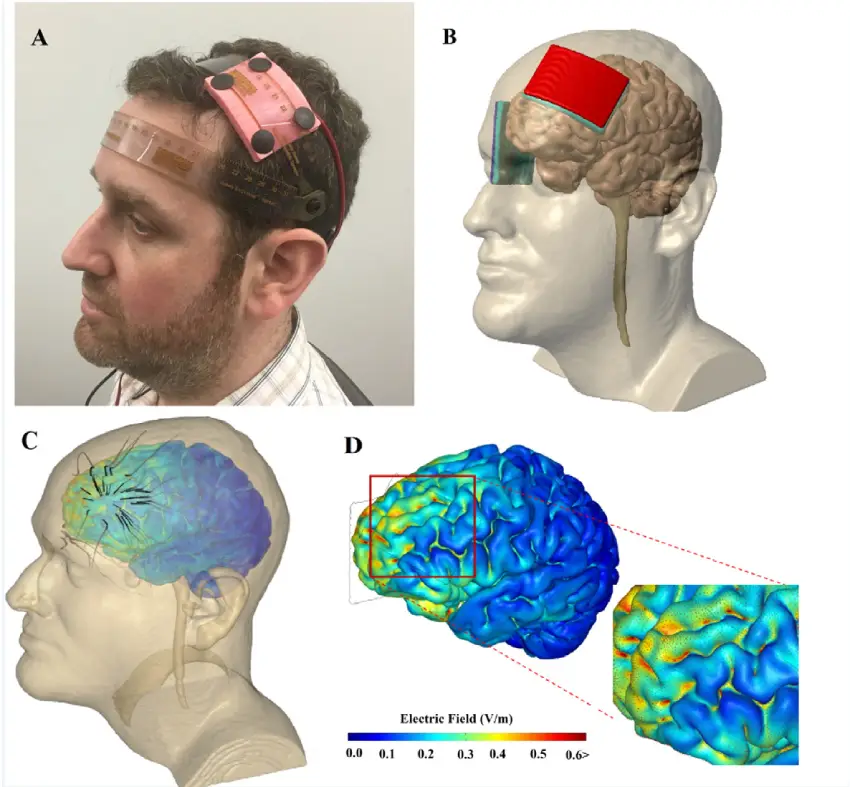 درمان اضطراب با tDCS