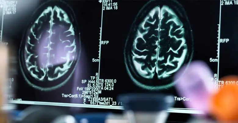 تاثیر ام ار ای بر افسردگی